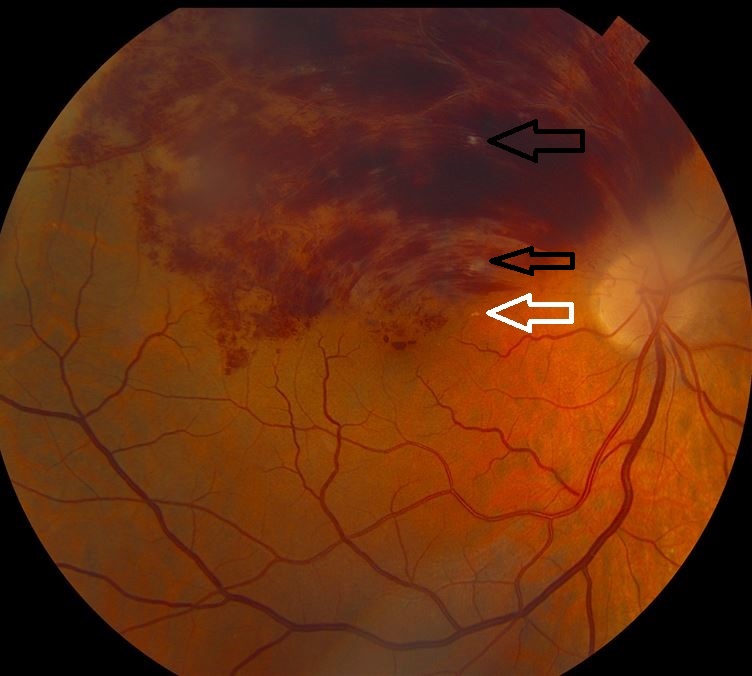 Branch Retinal Vein Occlusion in a Patient With Familial Hyperlipidemia Consultant360